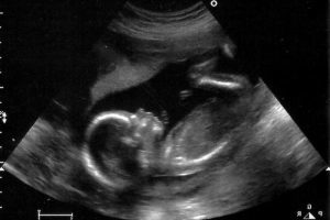 Женщины из других штатов едут в Орегон делать аборты. На фото развивающийся эмбрион