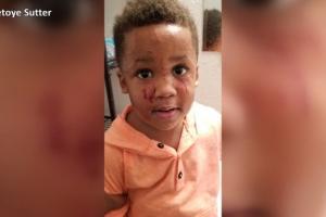 В детском саду в Миссисипи ребенок поцарапал полуторагодовалого мальчика. На фото Dakota Sutter